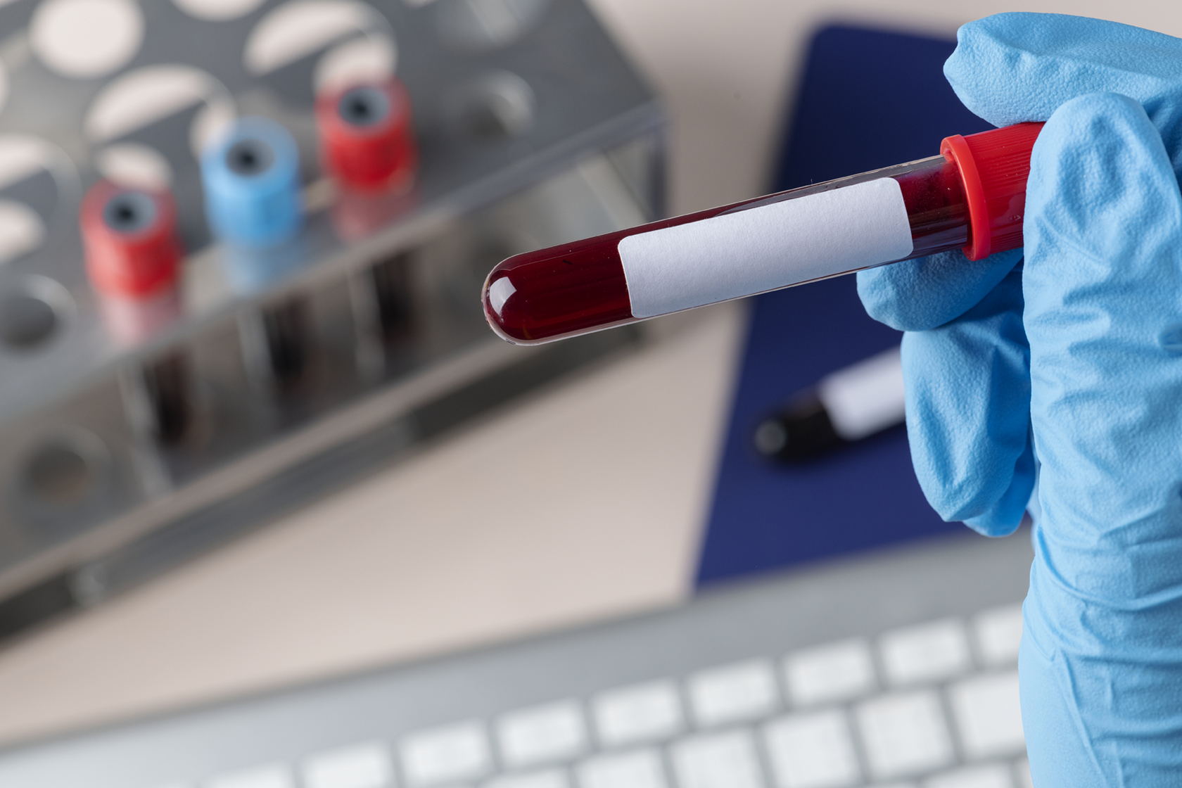 Surgeon holding a blood test